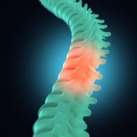 Spine - Slipped Disc