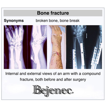 Bejenec - Bone Fracture