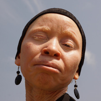 Tanzania Albinism Collective - Albinism Unity (We Are Still Living In A Challenging World)