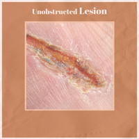 Charne Lolla - Unobstructed Lesion