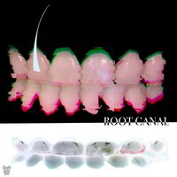 Cob - Root Canal